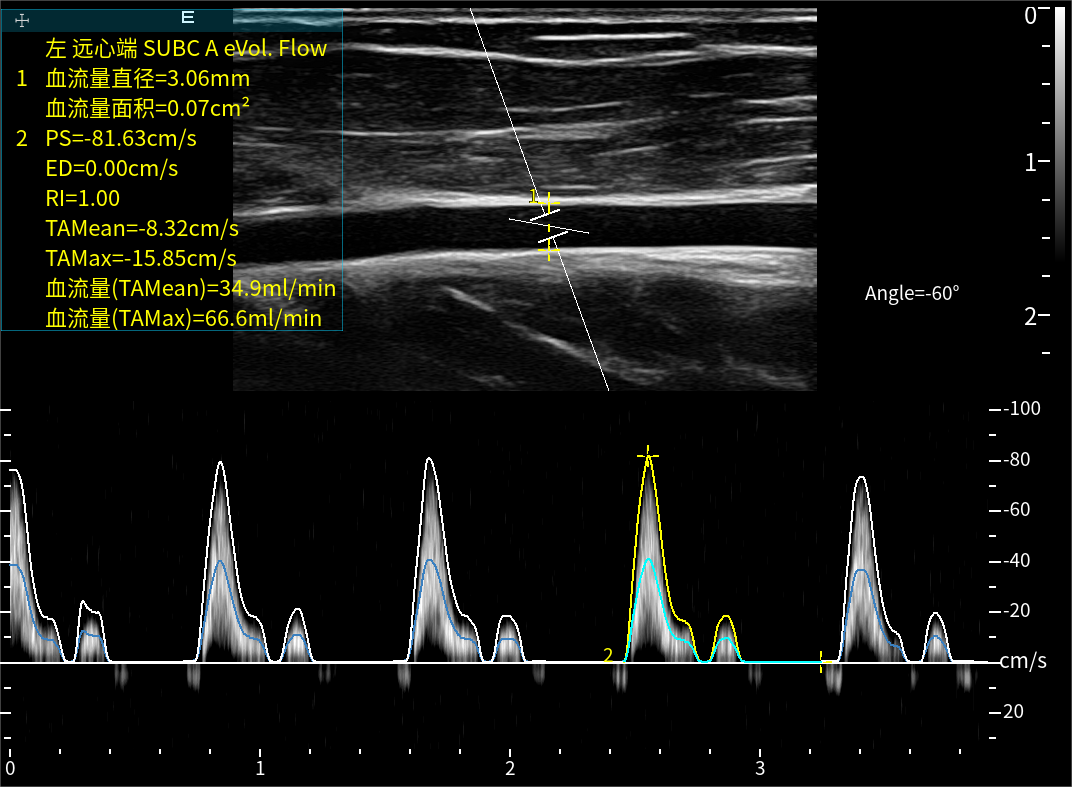 eVol.Flow一键血流量自动测量